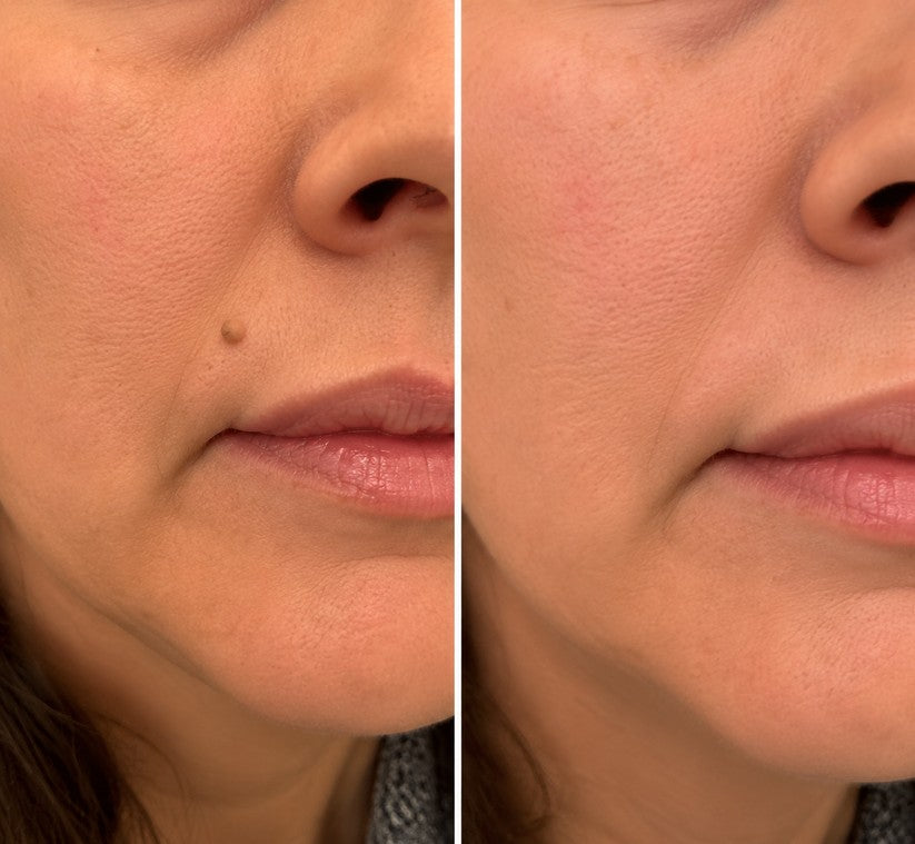 2-in-1 Microneedle & Hydrocolloid Patch 🌿 Invisible Face & Body Patches for Raised Moles, Acne, Flat Warts & Skin Tags - Helps Improve the Appearance of Wrinkles, Scars & Blemishes