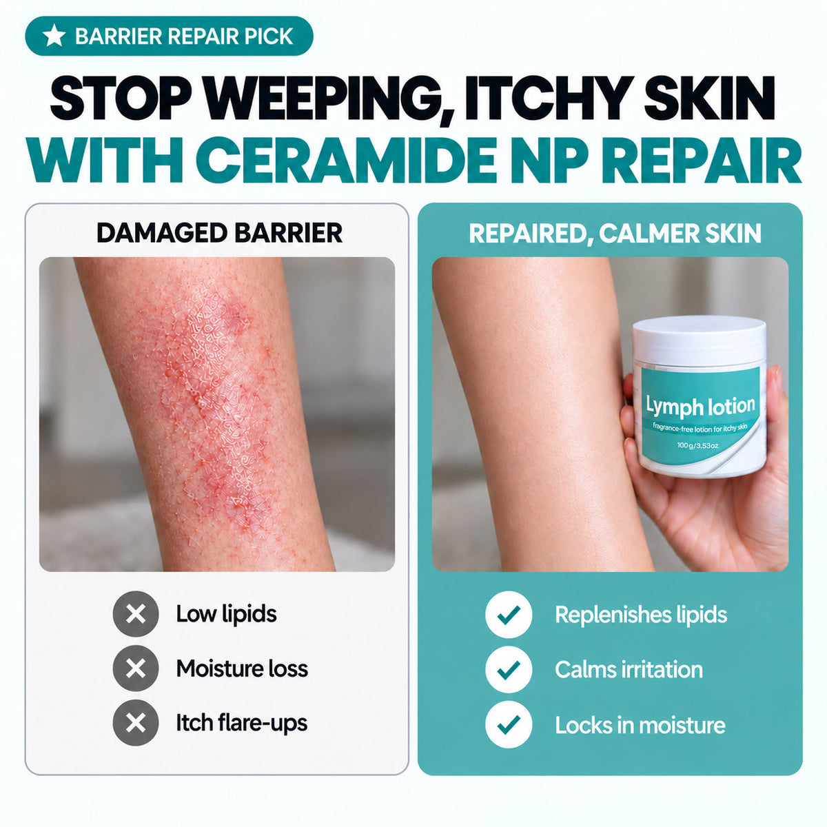 Fragrance-Free Non-Greasy Anti-Itch Ceramide NP Leg Lotion For Dry, Red, Sensitive, Discolored, Weeping