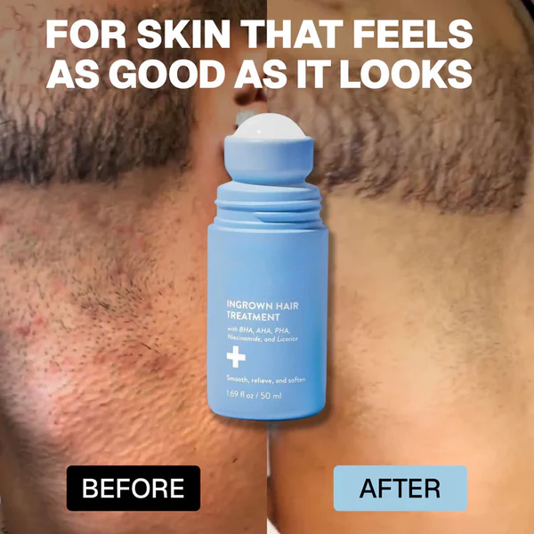 Tryskintle: Smoothing Solution For Ingrown Hairs