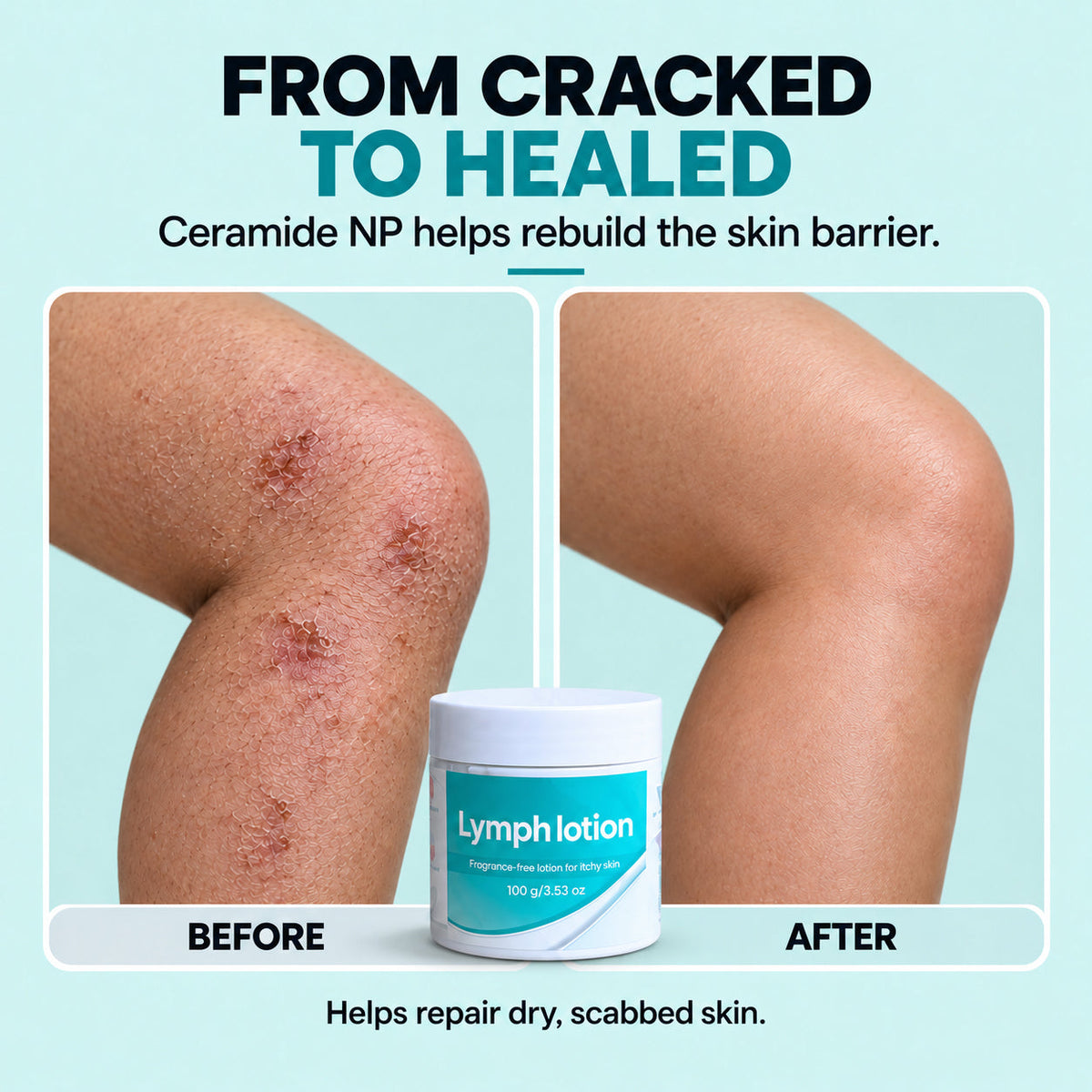 Fragrance-Free Non-Greasy Anti-Itch Ceramide NP Leg Lotion For Dry, Red, Sensitive, Discolored, Weeping