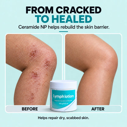 Fragrance-Free Non-Greasy Anti-Itch Ceramide NP Leg Lotion For Dry, Red, Sensitive, Discolored, Weeping