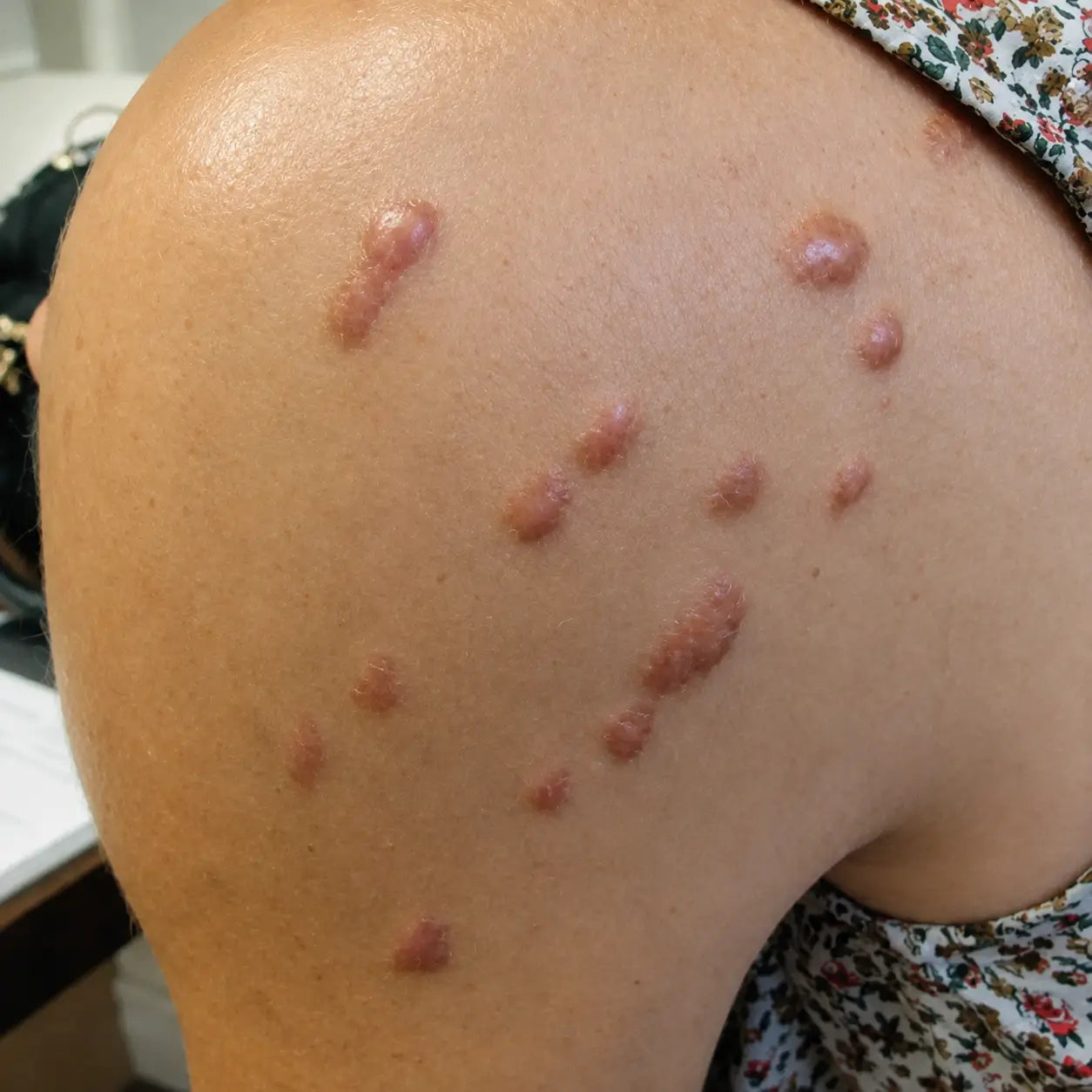 Before scar treatment