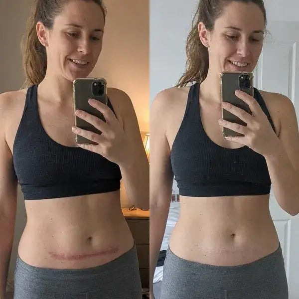 Flatter, Smoother, Calmer Scars in as Little as 3 Days