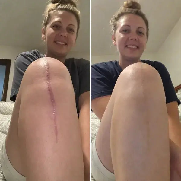 Flatter, Smoother, Calmer Scars in as Little as 3 Days