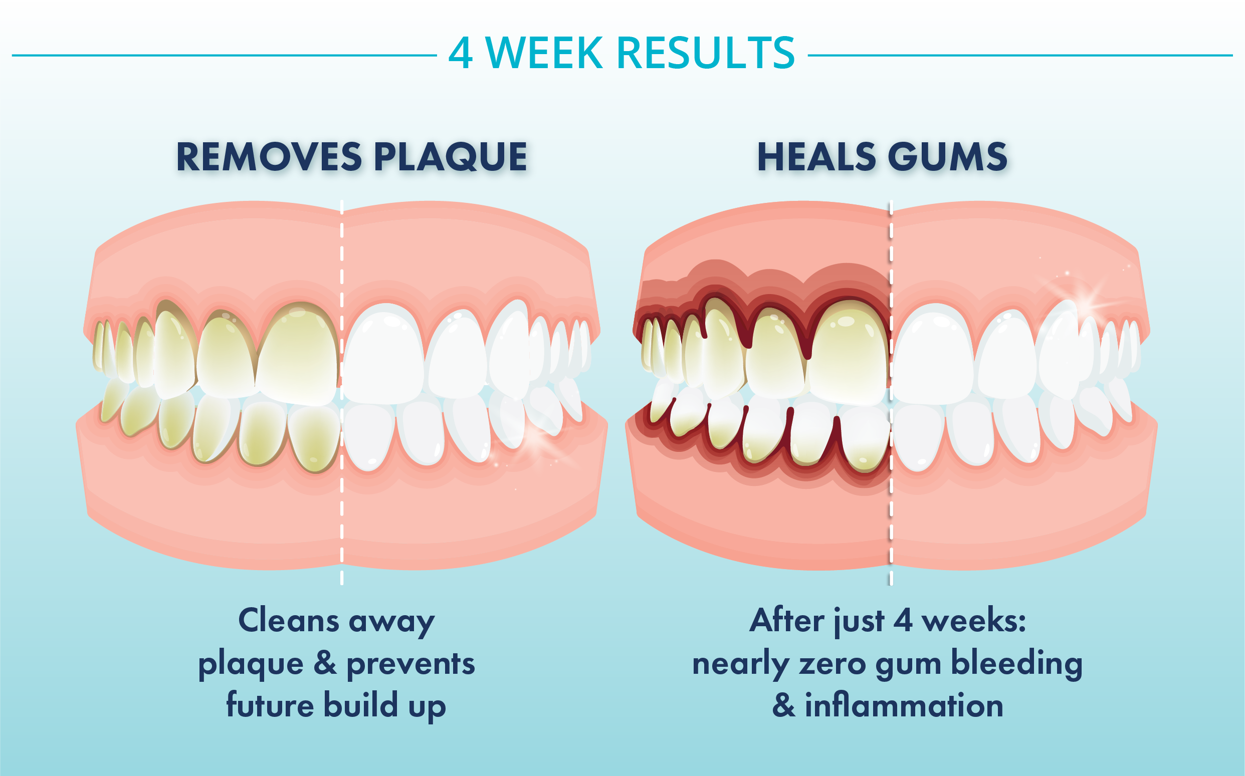 Four week plaque and gum results