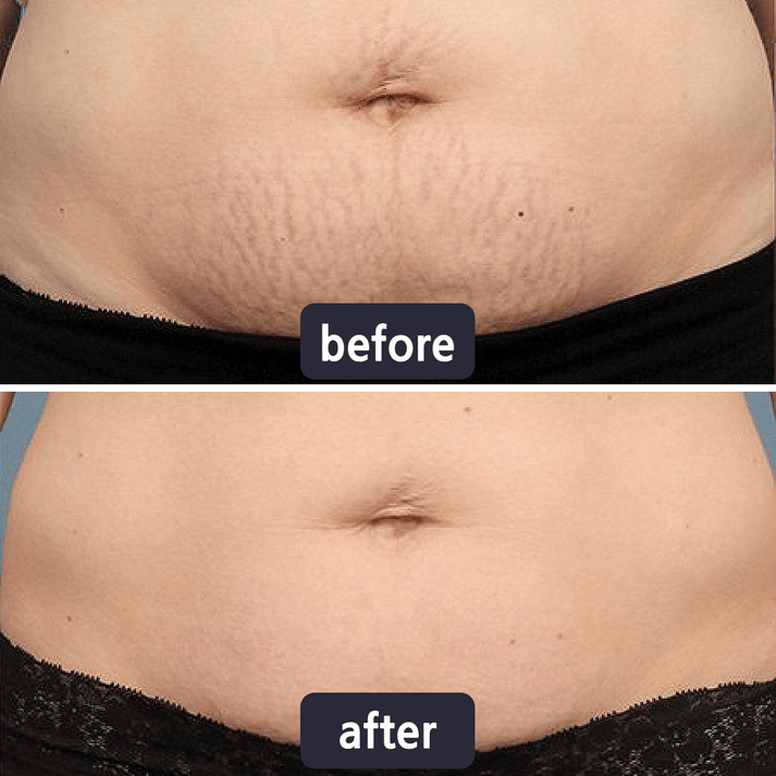Tryskintle Scar Removal Cream