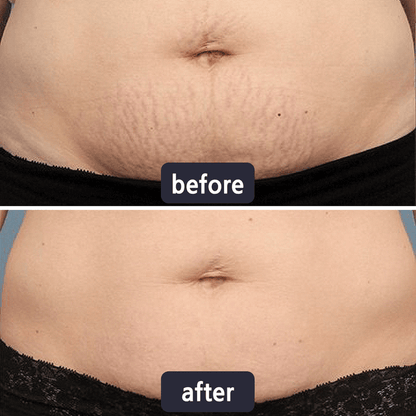 Tryskintle Scar Removal Cream