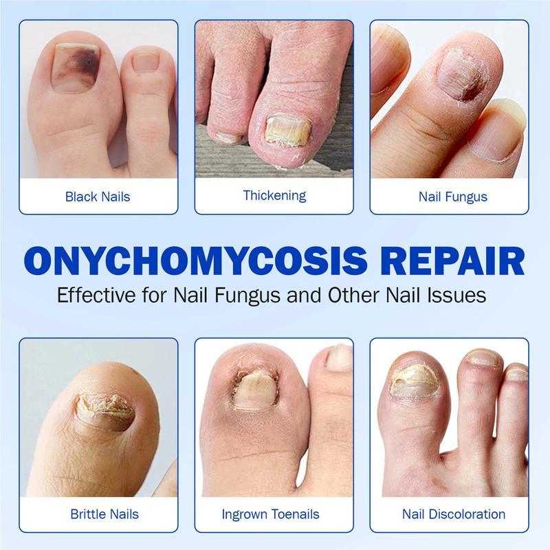 Fungal Nail Repair Patches