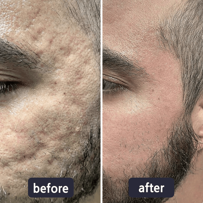 Tryskintle Scar Removal Cream