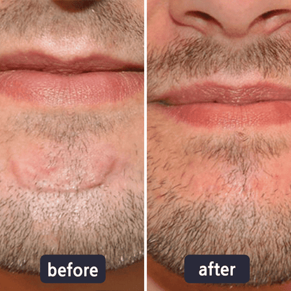 Tryskintle Scar Removal Cream