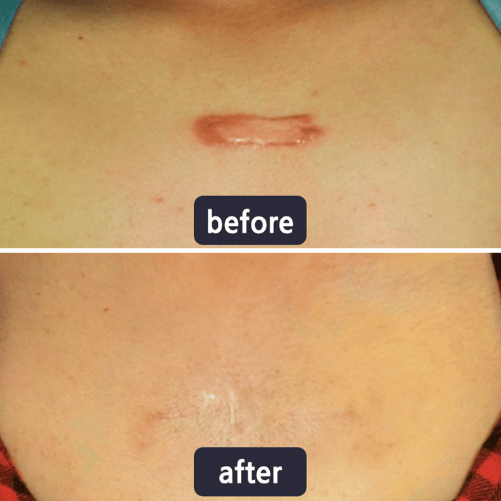 Tryskintle Scar Removal Cream