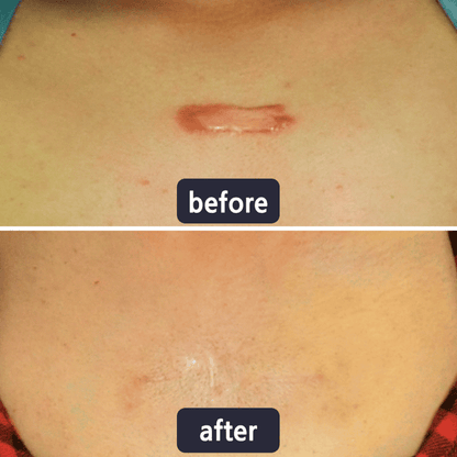 Tryskintle Scar Removal Cream