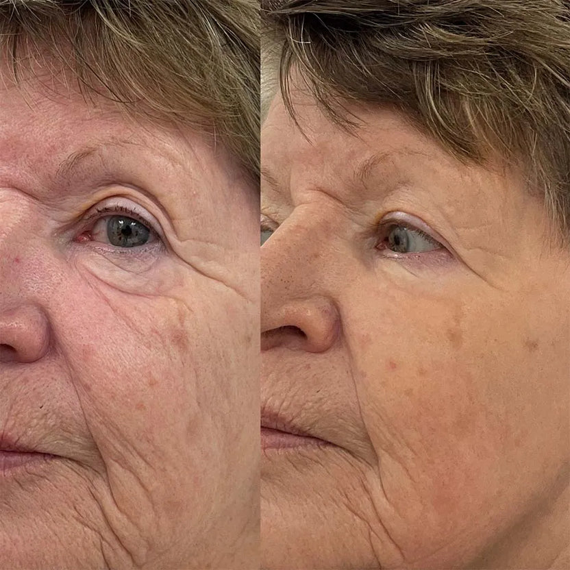 pt-ad2081661bfd-688b5c42efe2a55934466d26_exosomes-under-eyes-5.jpg
