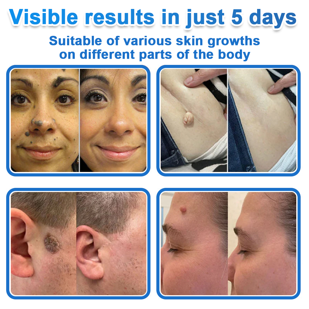 🎁 2-in-1 Microneedle & Hydrocolloid Patch | Raised Moles,Acne,  Flat Warts & Skin Tags Remover | Improves Wrinkles, Scars & Blemishes | Invisible Pimple Patches for Face & Body