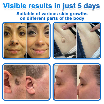🎁 2-in-1 Microneedle & Hydrocolloid Patch | Raised Moles,Acne,  Flat Warts & Skin Tags Remover | Improves Wrinkles, Scars & Blemishes | Invisible Pimple Patches for Face & Body