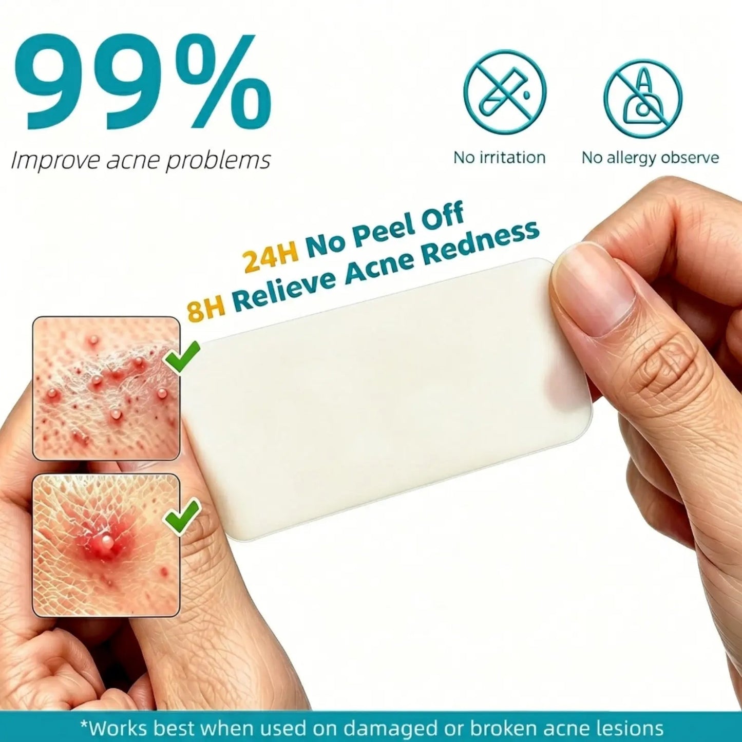 Hydrocolloid Acne Patch Roll – Cut to Any Size, 2 in × 16 ft