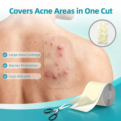 Hydrocolloid Acne Patch Roll – Cut to Any Size, 2 in × 16 ft