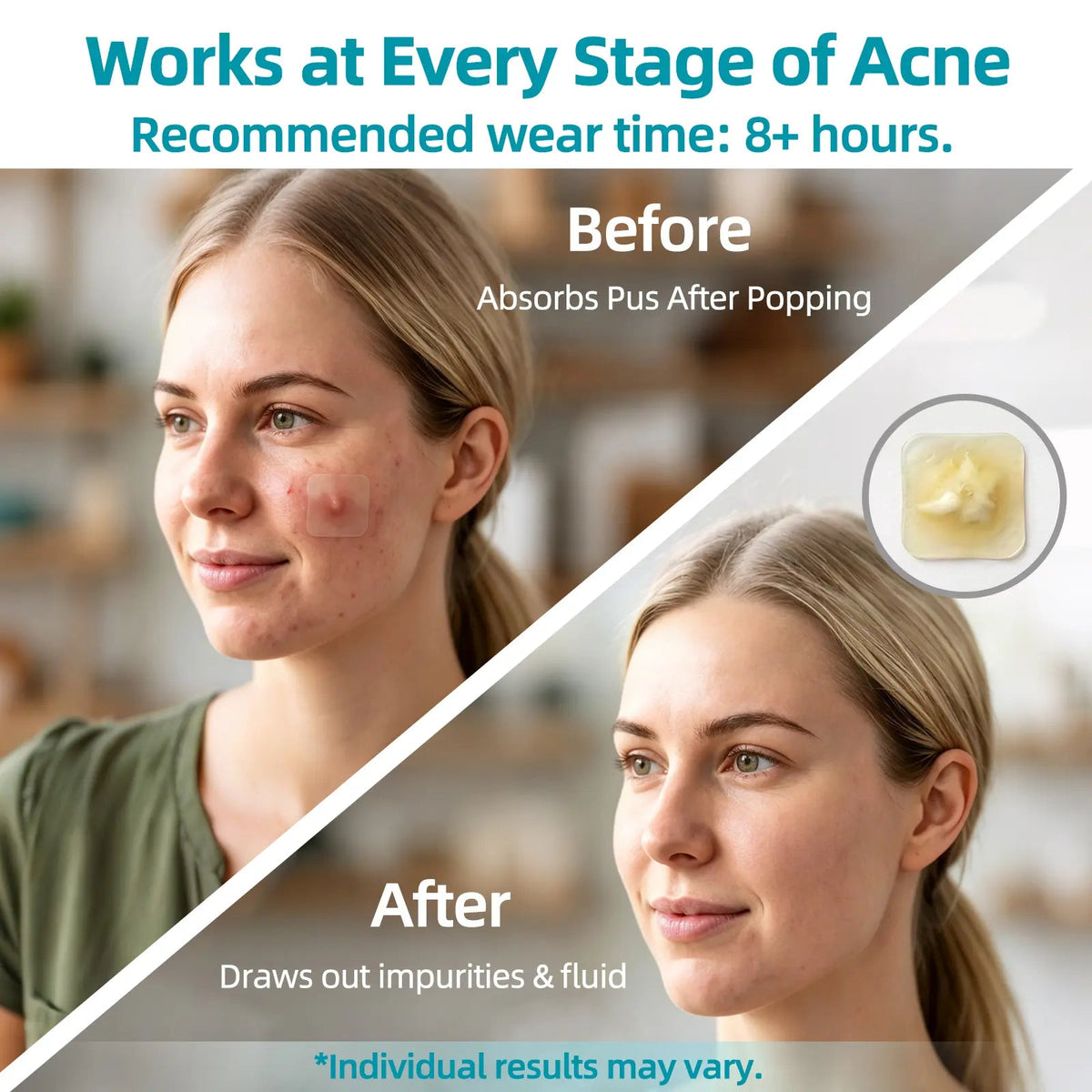 Hydrocolloid Acne Patch Roll – Cut to Any Size, 2 in × 16 ft